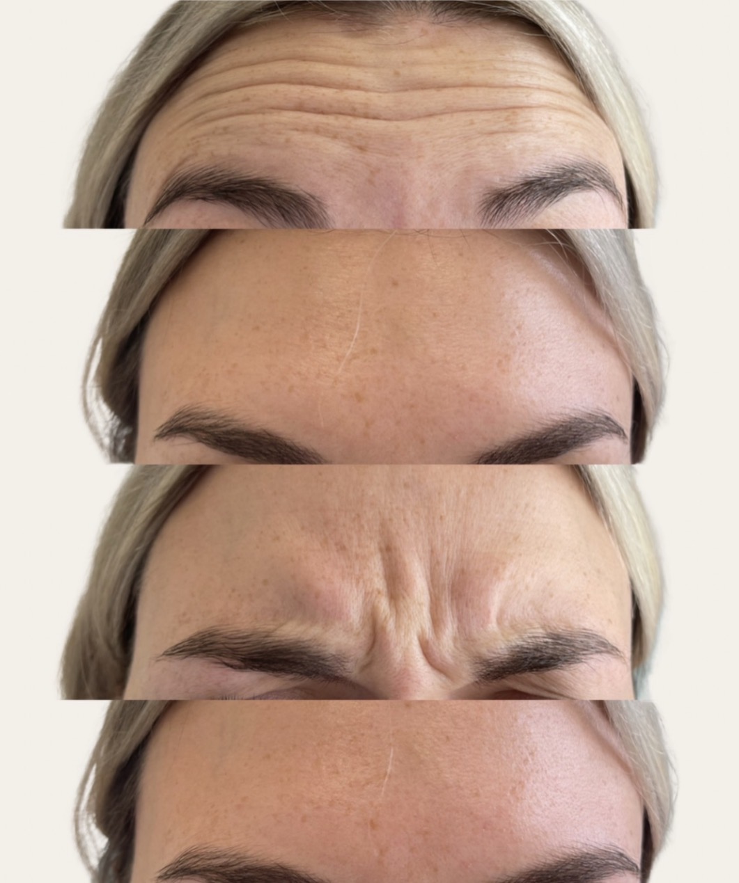 Anti-Wrinkle Treatment