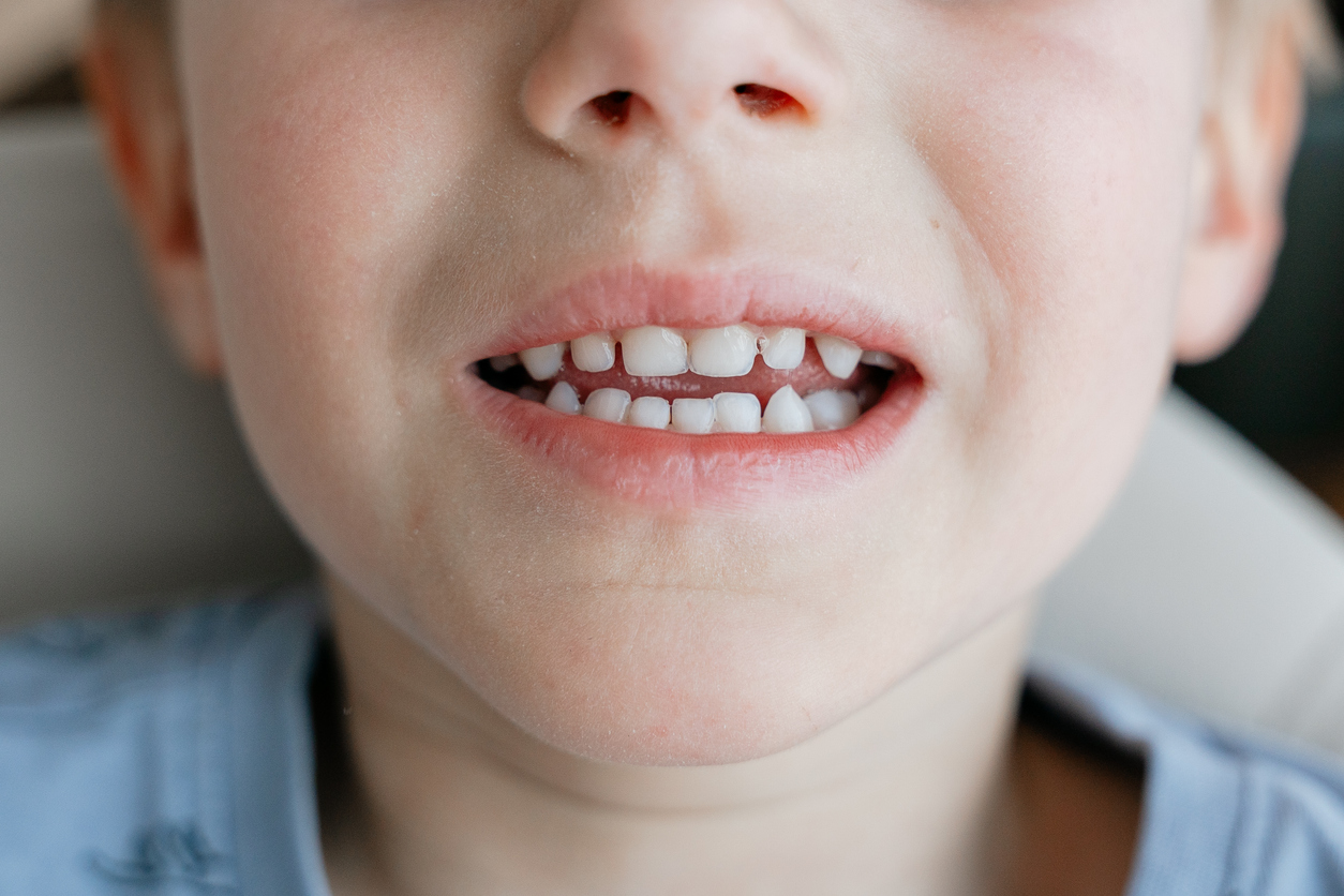 Fissure Sealants